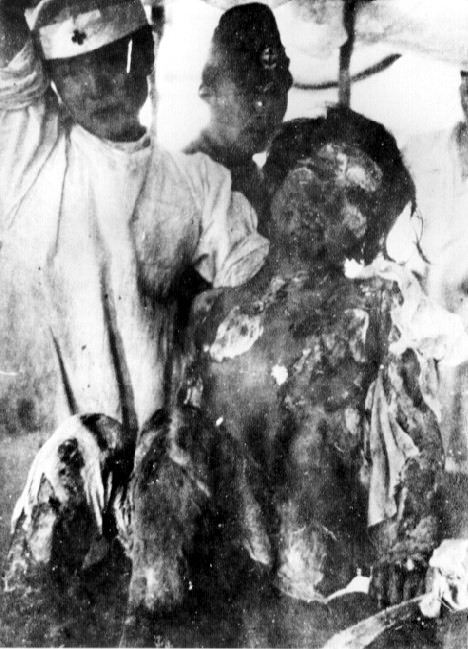 Victim_of_Atomic_Bomb_of_Nagasaki_01 大村海軍病院にて。全身に大火傷を負った14歳の少女（1945年8月10日撮影）